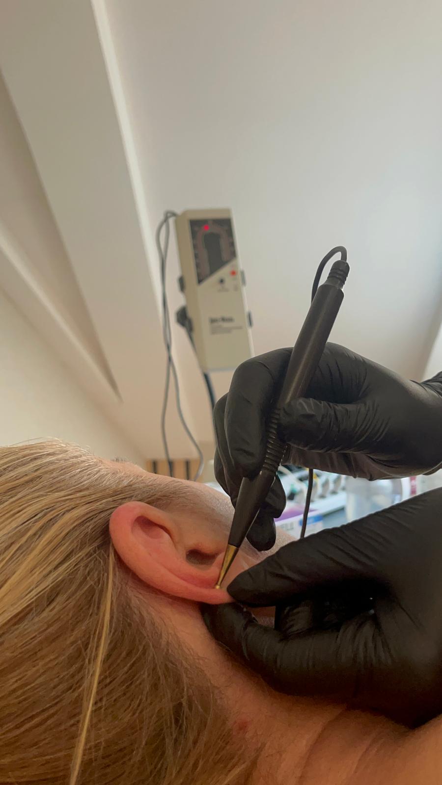 sta sve leci akupunktura