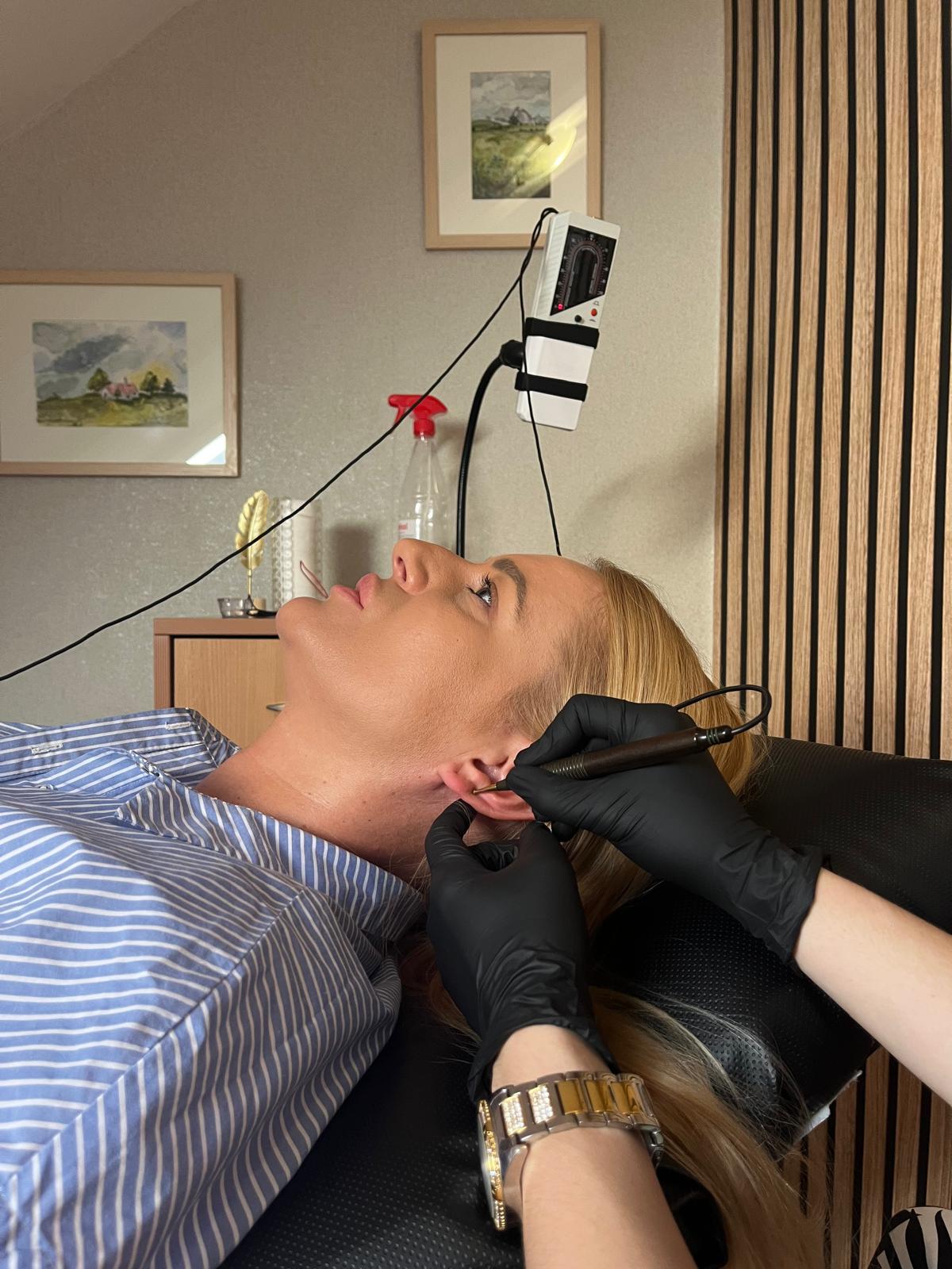 akupunktura za stres